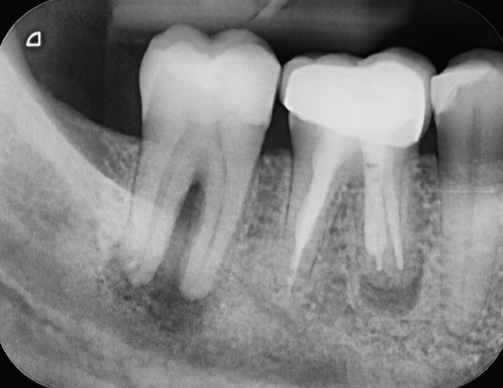 Endodoncia: Zachráňte svoj mŕtvy zub pred vytrhnutím (extrakciou)