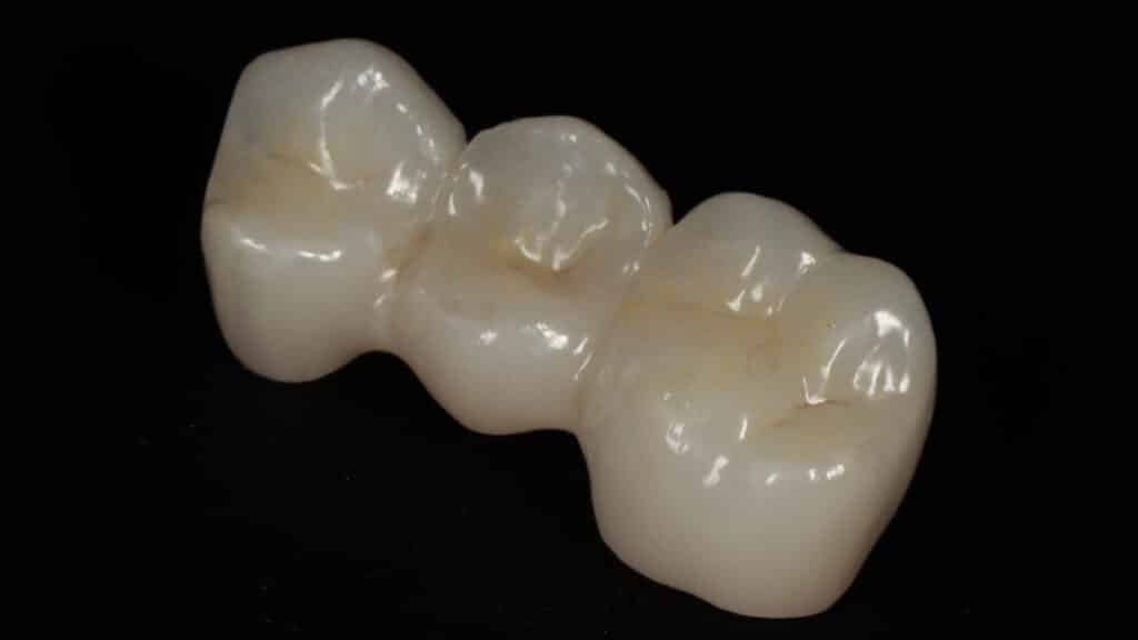 Endodoncia: Zachráňte svoj mŕtvy zub pred vytrhnutím (extrakciou)