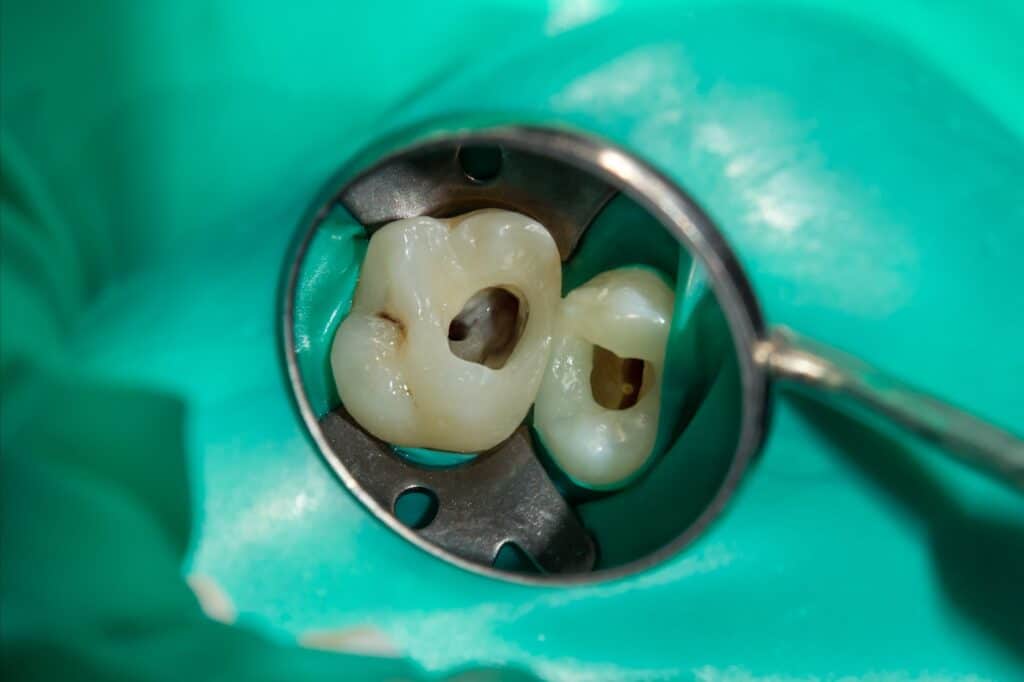 Endodoncia: Zachráňte svoj mŕtvy zub pred vytrhnutím (extrakciou)