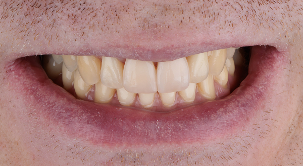 Fotokompozitné fazety - potom